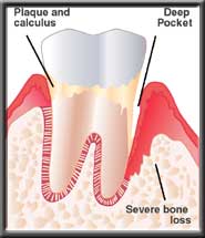 advanced periodontitis