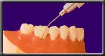 atridox being injected in periodontal pocket