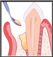 placing synthetic bone