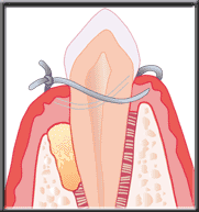 synthetic bone placed in defect