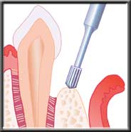 pitted bone re-contoured during osseous surgery