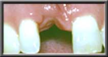 severe ridge defect after extracton