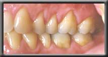 root coverage upper premolars right side image one