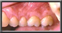 root coverage upper premolar right  side image two