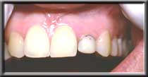 short lateral tooth with low gum