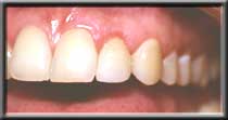 gum made level with adjacent teeth