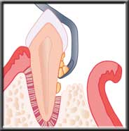 flap reflected to access deep plaque and calculus