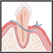 flap sutured tightly down to recontour bone