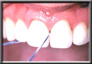 example image of flossing between teeth