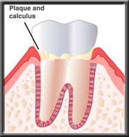 diagram of tooth with plaque and calculus buildup