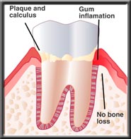 diagram of the beginning of gingivitis