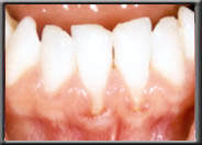 recession with a lack of attached gingiva