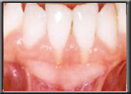 gum graft placed results in adequate gingiva