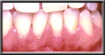 after placement of new attached gum