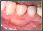 after placement of a gum graft further bone and tissue loss prevented