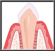 synthetic bone stimulates regeneration of natural bone