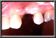 missing tooth replaced with implant supported crown