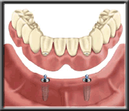 implant diagram 10