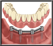 implant diagram 11