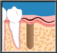 implant drawing 2