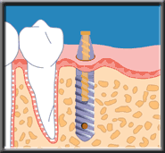 implant drawing 6