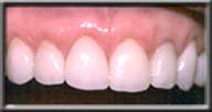 after gum recontouring and crown