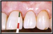 periodontal probe ready to measure pocket