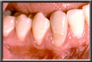 insufficient gum continued loss of gum and bone