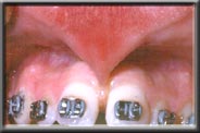 high frenum with lack of attached gum causing tooth separation