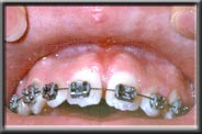 after frenum removal and addition of attached gingiva