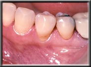 recession and lack of attached gingiva and bone