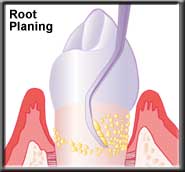 root planning smoothes root surface