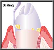 scaling removes plaque and calculus