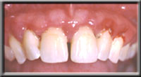 plaque causing inflamed gums and gingivitis