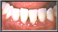 gingivitis with calculus seen between teeth