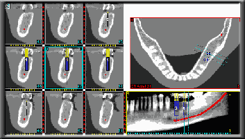 implant placement preview