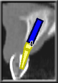 cross section view to determine implant placement angle