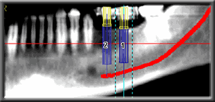 Measurments to determine implant final size