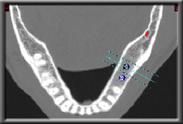 close up of lower jaw with natural teeth and implants