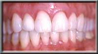 photograph of health gums